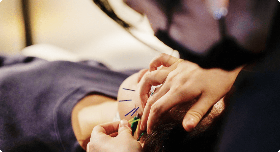 美容鍼の施術を受けている様子